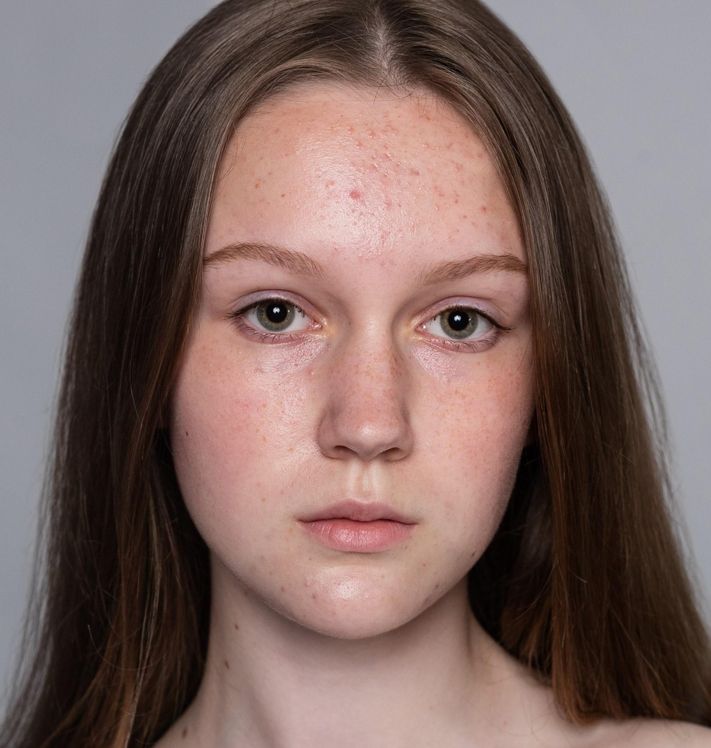 health, people, youth and beauty concept - Woman face before and after acne treatment procedure. Skin care concept.