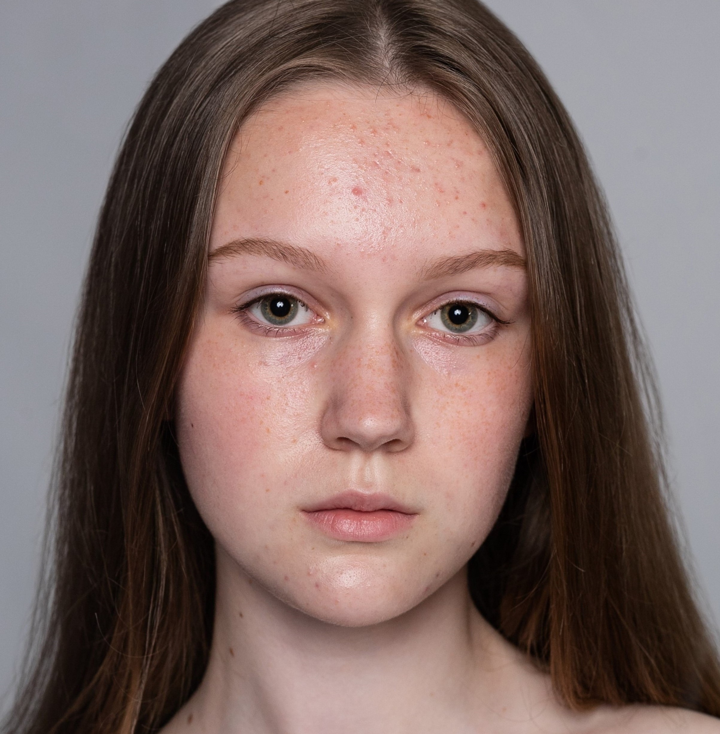 health, people, youth and beauty concept - Woman face before and after acne treatment procedure. Skin care concept.